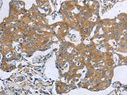 The image on the left is immunohistochemistry of paraffin-embedded Human breast cancer tissue using CSB-PA127569(TNK2 Antibody) at dilution 1/70, on the right is treated with synthetic peptide. (Original magnification: ×200)
