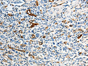The image on the left is immunohistochemistry of paraffin-embedded Human gastic cancer tissue using CSB-PA127583(ABCG1 Antibody) at dilution 1/40, on the right is treated with synthetic peptide. (Original magnification: ×200)