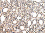 The image on the left is immunohistochemistry of paraffin-embedded Human thyroid cancer tissue using CSB-PA128038(VPS33A Antibody) at dilution 1/30, on the right is treated with fusion protein. (Original magnification: ×200)
