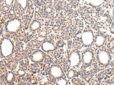 The image on the left is immunohistochemistry of paraffin-embedded Human thyroid cancer tissue using CSB-PA128038(VPS33A Antibody) at dilution 1/30, on the right is treated with fusion protein. (Original magnification: ×200)