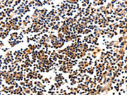 The image on the left is immunohistochemistry of paraffin-embedded Human tonsil tissue using CSB-PA128065(CAMK1 Antibody) at dilution 1/10, on the right is treated with fusion protein. (Original magnification: ×200)