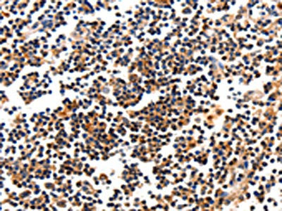 The image on the left is immunohistochemistry of paraffin-embedded Human tonsil tissue using CSB-PA128065(CAMK1 Antibody) at dilution 1/10, on the right is treated with fusion protein. (Original magnification: ×200)