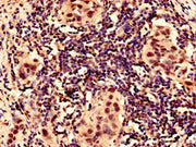 Immunocytochemistry analysis of human bladder cancer using CSB-PA12807A0Rb at dilution of 1:100