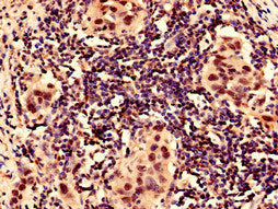 Immunocytochemistry analysis of human bladder cancer using CSB-PA12807A0Rb at dilution of 1:100
