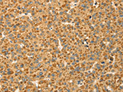 The image on the left is immunohistochemistry of paraffin-embedded Human liver cancer tissue using CSB-PA128390(CAPN7 Antibody) at dilution 1/20, on the right is treated with fusion protein. (Original magnification: ×200)