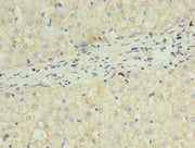Immunohistochemistry of paraffin-embedded human liver cancer using CSB-PA12847A0Rb at dilution of 1:100