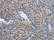 The image on the left is immunohistochemistry of paraffin-embedded Human liver cancer tissue using CSB-PA128816(IBSP Antibody) at dilution 1/30, on the right is treated with synthetic peptide. (Original magnification: ×200)