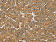 The image on the left is immunohistochemistry of paraffin-embedded Human liver cancer tissue using CSB-PA128984(SENP3 Antibody) at dilution 1/35, on the right is treated with synthetic peptide. (Original magnification: ×200)