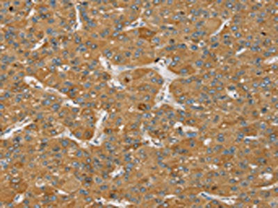 The image on the left is immunohistochemistry of paraffin-embedded Human liver cancer tissue using CSB-PA128984(SENP3 Antibody) at dilution 1/35, on the right is treated with synthetic peptide. (Original magnification: ×200)