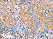 The image on the left is immunohistochemistry of paraffin-embedded Human cervical cancer tissue using CSB-PA129011(ACADS Antibody) at dilution 1/15, on the right is treated with fusion protein. (Original magnification: ×200)