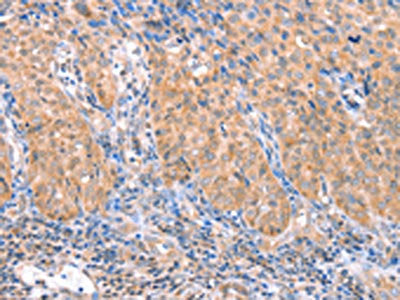 The image on the left is immunohistochemistry of paraffin-embedded Human cervical cancer tissue using CSB-PA129011(ACADS Antibody) at dilution 1/15, on the right is treated with fusion protein. (Original magnification: ×200)