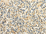 The image on the left is immunohistochemistry of paraffin-embedded Human prostate cancer tissue using CSB-PA129068(SLC6A19 Antibody) at dilution 1/25, on the right is treated with synthetic peptide. (Original magnification: ×200)