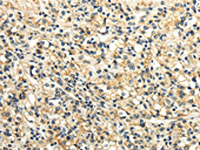 The image on the left is immunohistochemistry of paraffin-embedded Human prostate cancer tissue using CSB-PA129068(SLC6A19 Antibody) at dilution 1/25, on the right is treated with synthetic peptide. (Original magnification: ×200)