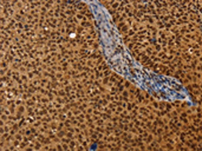 The image on the left is immunohistochemistry of paraffin-embedded Human cervical cancer tissue using CSB-PA129151(CEL Antibody) at dilution 1/40, on the right is treated with synthetic peptide. (Original magnification: ×200)