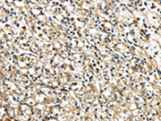 The image on the left is immunohistochemistry of paraffin-embedded Human prostate cancer tissue using CSB-PA129185(NME2 Antibody) at dilution 1/40, on the right is treated with synthetic peptide. (Original magnification: ×200)