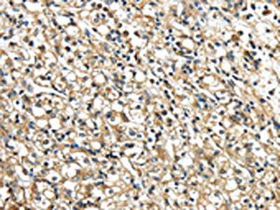 The image on the left is immunohistochemistry of paraffin-embedded Human prostate cancer tissue using CSB-PA129185(NME2 Antibody) at dilution 1/40, on the right is treated with synthetic peptide. (Original magnification: ×200)