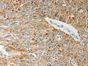 The image on the left is immunohistochemistry of paraffin-embedded Human ovarian cancer tissue using CSB-PA129196(COL4A3 Antibody) at dilution 1/20, on the right is treated with synthetic peptide. (Original magnification: ×200)