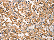 The image on the left is immunohistochemistry of paraffin-embedded Human thyroid cancer tissue using CSB-PA129519(CRKL Antibody) at dilution 1/25, on the right is treated with synthetic peptide. (Original magnification: ×200)