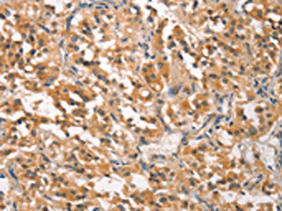 The image on the left is immunohistochemistry of paraffin-embedded Human thyroid cancer tissue using CSB-PA129519(CRKL Antibody) at dilution 1/25, on the right is treated with synthetic peptide. (Original magnification: ×200)