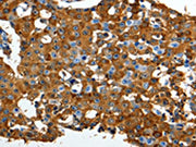 The image on the left is immunohistochemistry of paraffin-embedded Human breast cancer tissue using CSB-PA129534(LRP1 Antibody) at dilution 1/90, on the right is treated with synthetic peptide. (Original magnification: ×200)