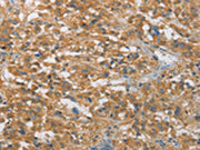 The image on the left is immunohistochemistry of paraffin-embedded Human thyroid cancer tissue using CSB-PA129637(FASLG Antibody) at dilution 1/30, on the right is treated with synthetic peptide. (Original magnification: ×200)