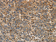 The image on the left is immunohistochemistry of paraffin-embedded Human liver cancer tissue using CSB-PA129669(ARF6 Antibody) at dilution 1/30, on the right is treated with synthetic peptide. (Original magnification: ×200)