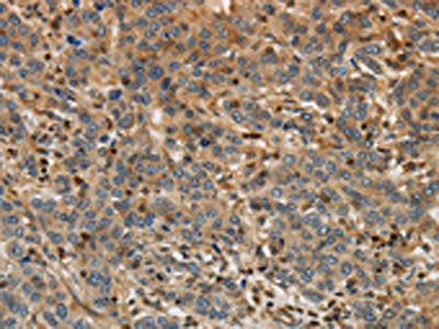 The image on the left is immunohistochemistry of paraffin-embedded Human liver cancer tissue using CSB-PA129669(ARF6 Antibody) at dilution 1/30, on the right is treated with synthetic peptide. (Original magnification: ×200)