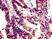 IHC image of CSB-PA12989A0Rb diluted at 1:400 and staining in paraffin-embedded human ovarian cancer performed on a Leica BondTM system. After dewaxing and hydration, antigen retrieval was mediated by high pressure in a citrate buffer (pH 6.0). Se...
