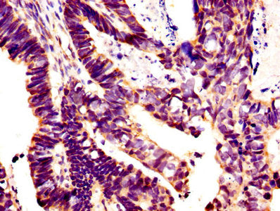 IHC image of CSB-PA12989A0Rb diluted at 1:400 and staining in paraffin-embedded human ovarian cancer performed on a Leica BondTM system. After dewaxing and hydration, antigen retrieval was mediated by high pressure in a citrate buffer (pH 6.0). Se...