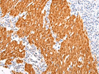 The image on the left is immunohistochemistry of paraffin-embedded Human gastric cancer tissue using CSB-PA129979(BSN Antibody) at dilution 1/20, on the right is treated with synthetic peptide. (Original magnification: ×200)