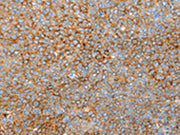 The image on the left is immunohistochemistry of paraffin-embedded Human ovarian cancer tissue using CSB-PA129980(SNX33 Antibody) at dilution 1/25, on the right is treated with synthetic peptide. (Original magnification: ×200)