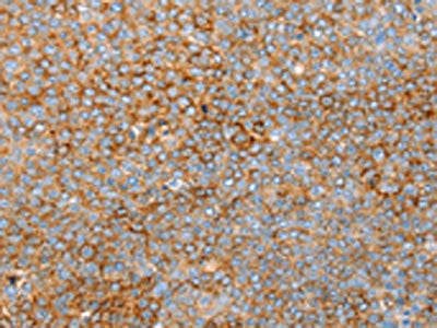 The image on the left is immunohistochemistry of paraffin-embedded Human ovarian cancer tissue using CSB-PA129980(SNX33 Antibody) at dilution 1/25, on the right is treated with synthetic peptide. (Original magnification: ×200)