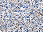 The image on the left is immunohistochemistry of paraffin-embedded Human thyroid cancer tissue using CSB-PA130040(PIM1 Antibody) at dilution 1/50, on the right is treated with fusion protein. (Original magnification: ×200)