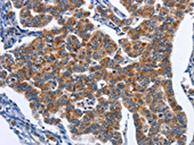 The image on the left is immunohistochemistry of paraffin-embedded Human breast cancer tissue using CSB-PA130108(CADM3 Antibody) at dilution 1/40, on the right is treated with fusion protein. (Original magnification: ×200)