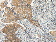 The image on the left is immunohistochemistry of paraffin-embedded Human cervical cancer tissue using CSB-PA130147(VIPR2 Antibody) at dilution 1/35, on the right is treated with synthetic peptide. (Original magnification: ×200)