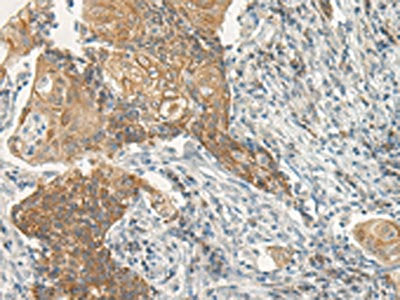 The image on the left is immunohistochemistry of paraffin-embedded Human cervical cancer tissue using CSB-PA130147(VIPR2 Antibody) at dilution 1/35, on the right is treated with synthetic peptide. (Original magnification: ×200)