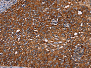 The image on the left is immunohistochemistry of paraffin-embedded Human cervical cancer tissue using CSB-PA130250(CYP2W1 Antibody) at dilution 1/60, on the right is treated with fusion protein. (Original magnification: ×200)