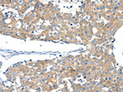 The image on the left is immunohistochemistry of paraffin-embedded Human breast cancer tissue using CSB-PA130335(SSTR3 Antibody) at dilution 1/40, on the right is treated with synthetic peptide. (Original magnification: ×200)