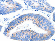The image on the left is immunohistochemistry of paraffin-embedded Human colon cancer tissue using CSB-PA130507(MUC3A Antibody) at dilution 1/60, on the right is treated with synthetic peptide. (Original magnification: ×200)