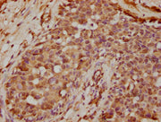 IHC image of CSB-PA13057A0Rb diluted at 1:400 and staining in paraffin-embedded human breast cancer performed on a Leica BondTM system. After dewaxing and hydration, antigen retrieval was mediated by high pressure in a citrate buffer (pH 6.0). Sec...