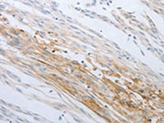 The image on the left is immunohistochemistry of paraffin-embedded Human cervical cancer tissue using CSB-PA130669(LOX Antibody) at dilution 1/30, on the right is treated with synthetic peptide. (Original magnification: ×200)