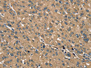 The image on the left is immunohistochemistry of paraffin-embedded Human liver cancer tissue using CSB-PA131097(TRIM3 Antibody) at dilution 1/40, on the right is treated with synthetic peptide. (Original magnification: ×200)