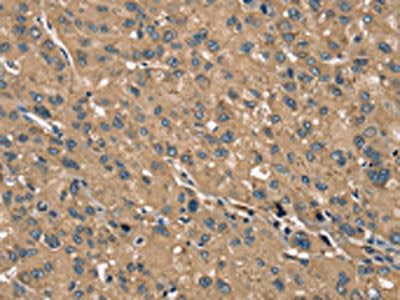 The image on the left is immunohistochemistry of paraffin-embedded Human liver cancer tissue using CSB-PA131097(TRIM3 Antibody) at dilution 1/40, on the right is treated with synthetic peptide. (Original magnification: ×200)