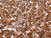 The image on the left is immunohistochemistry of paraffin-embedded Human thyroid cancer tissue using CSB-PA131138(ARL4A Antibody) at dilution 1/50, on the right is treated with fusion protein. (Original magnification: ×200)