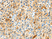 The image on the left is immunohistochemistry of paraffin-embedded Human liver cancer tissue using CSB-PA131148(MAP3K10 Antibody) at dilution 1/35, on the right is treated with synthetic peptide. (Original magnification: ×200)