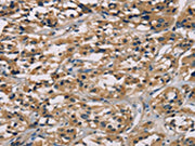The image on the left is immunohistochemistry of paraffin-embedded Human thyroid cancer tissue using CSB-PA131153(CGA Antibody) at dilution 1/65, on the right is treated with fusion protein. (Original magnification: ×200)