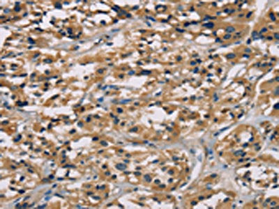 The image on the left is immunohistochemistry of paraffin-embedded Human thyroid cancer tissue using CSB-PA131153(CGA Antibody) at dilution 1/65, on the right is treated with fusion protein. (Original magnification: ×200)