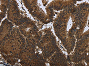 The image on the left is immunohistochemistry of paraffin-embedded Human colon cancer tissue using CSB-PA131180(PIP Antibody) at dilution 1/50, on the right is treated with fusion protein. (Original magnification: ×200)