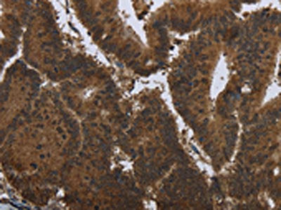 The image on the left is immunohistochemistry of paraffin-embedded Human colon cancer tissue using CSB-PA131180(PIP Antibody) at dilution 1/50, on the right is treated with fusion protein. (Original magnification: ×200)
