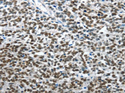 The image on the left is immunohistochemistry of paraffin-embedded Human ovarian cancer tissue using CSB-PA131190(ARL2 Antibody) at dilution 1/15, on the right is treated with fusion protein. (Original magnification: ×200)